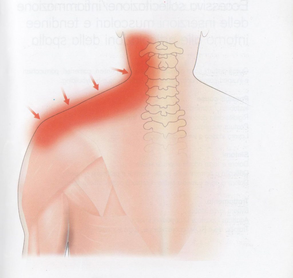 Dolore muscolare a collo e spalle