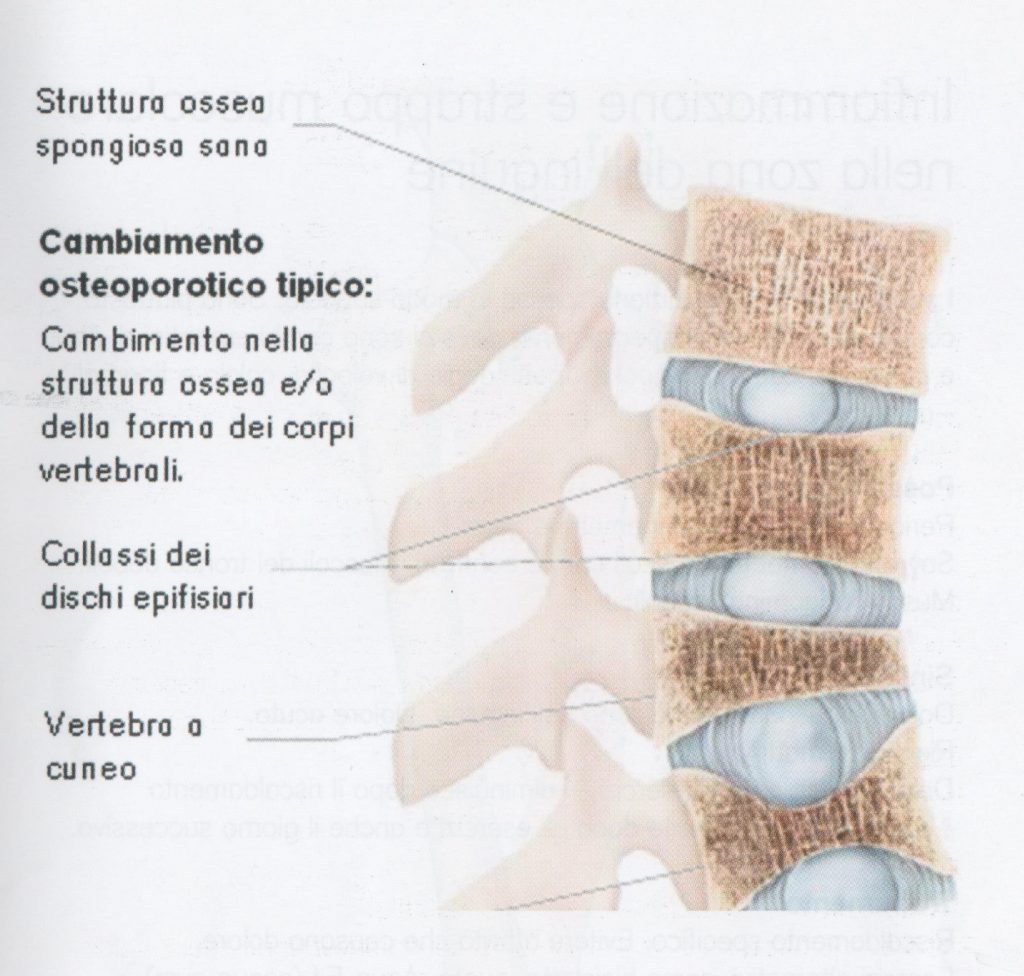 Osteoporosi