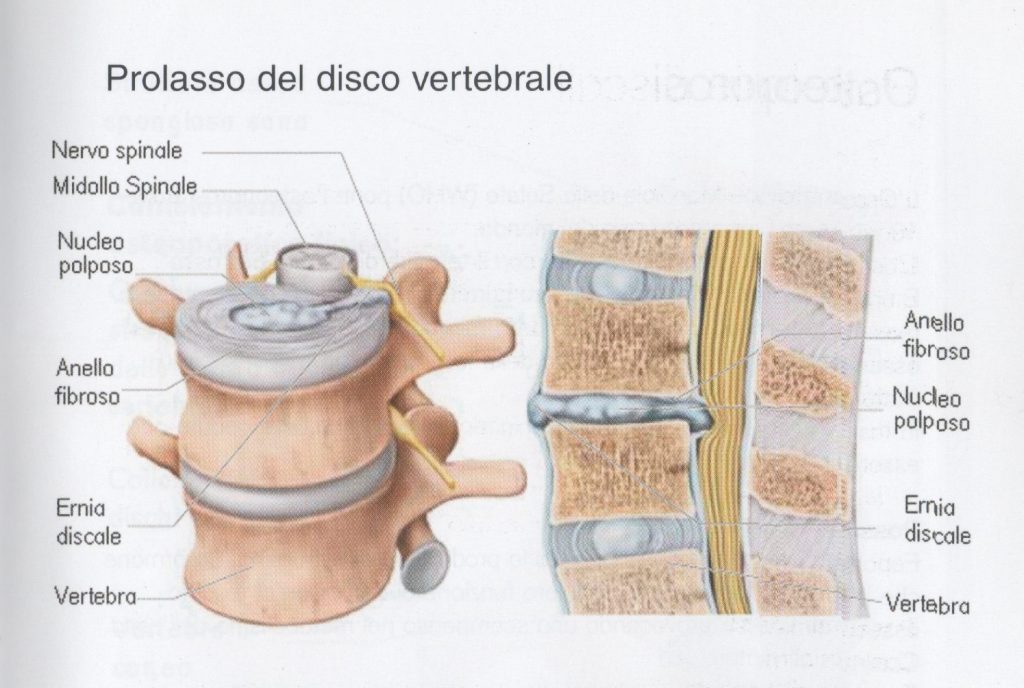 Patologie discali