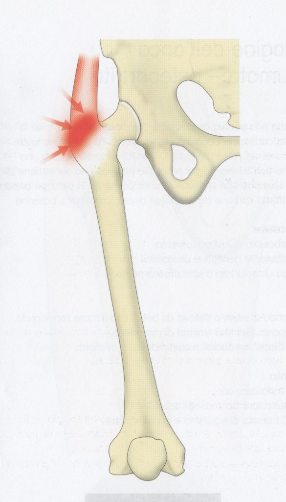 Infiammazione nella zona delle anche