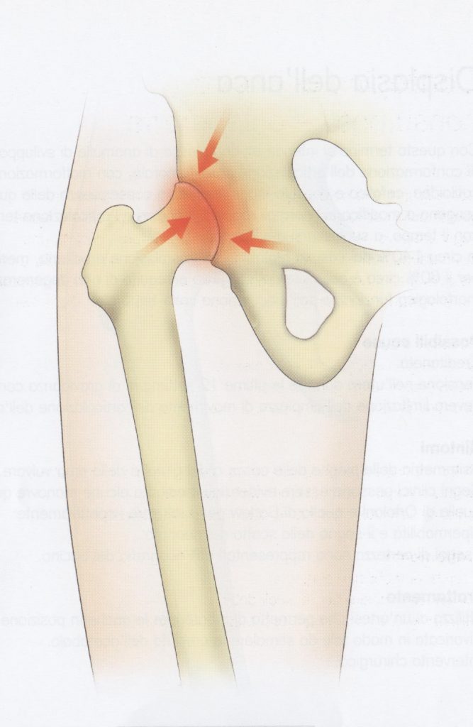 Cartilagine anca consumata (osteoartite)