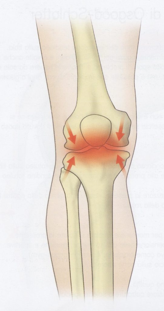 Lesione da usura del ginocchio (osteoartrite)