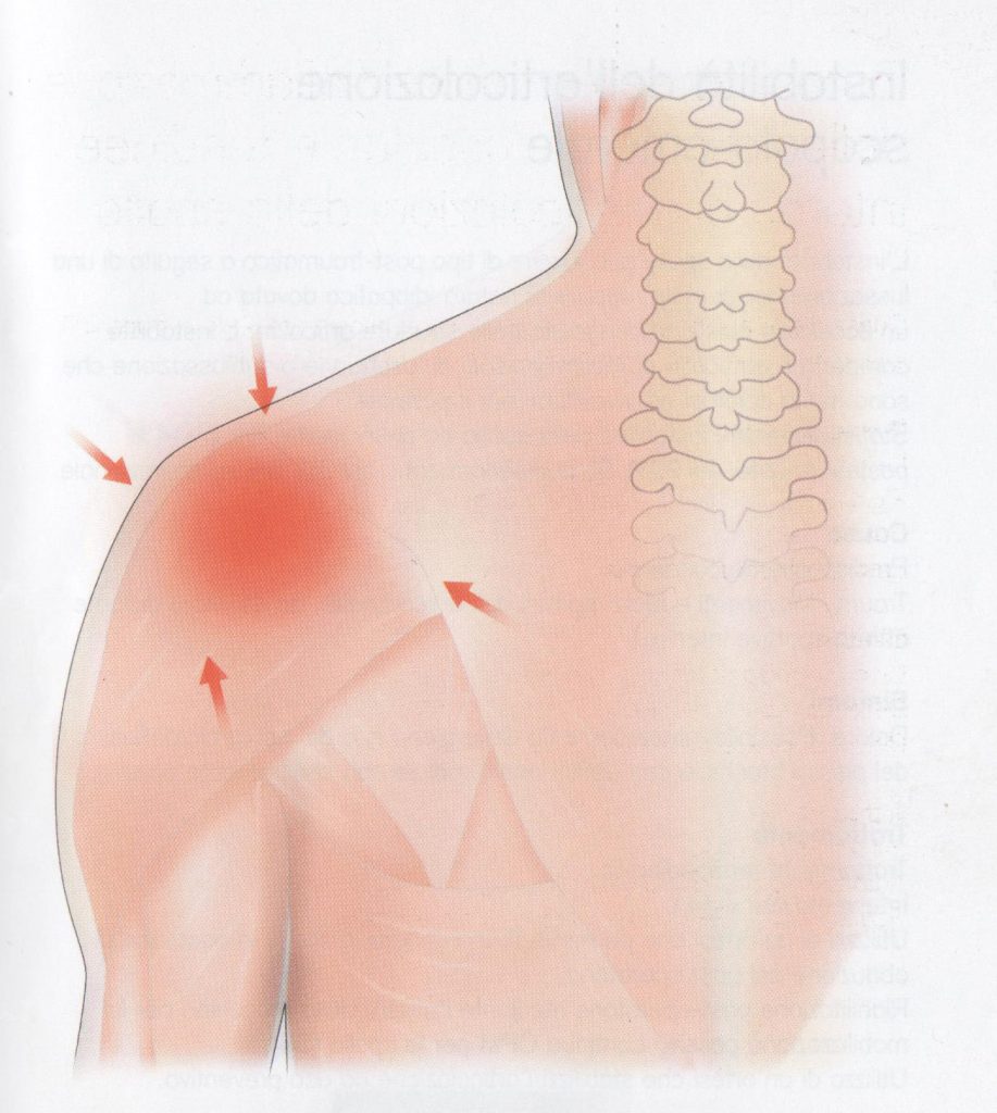 Infiammazione – dolore dell’articolazione della spalla