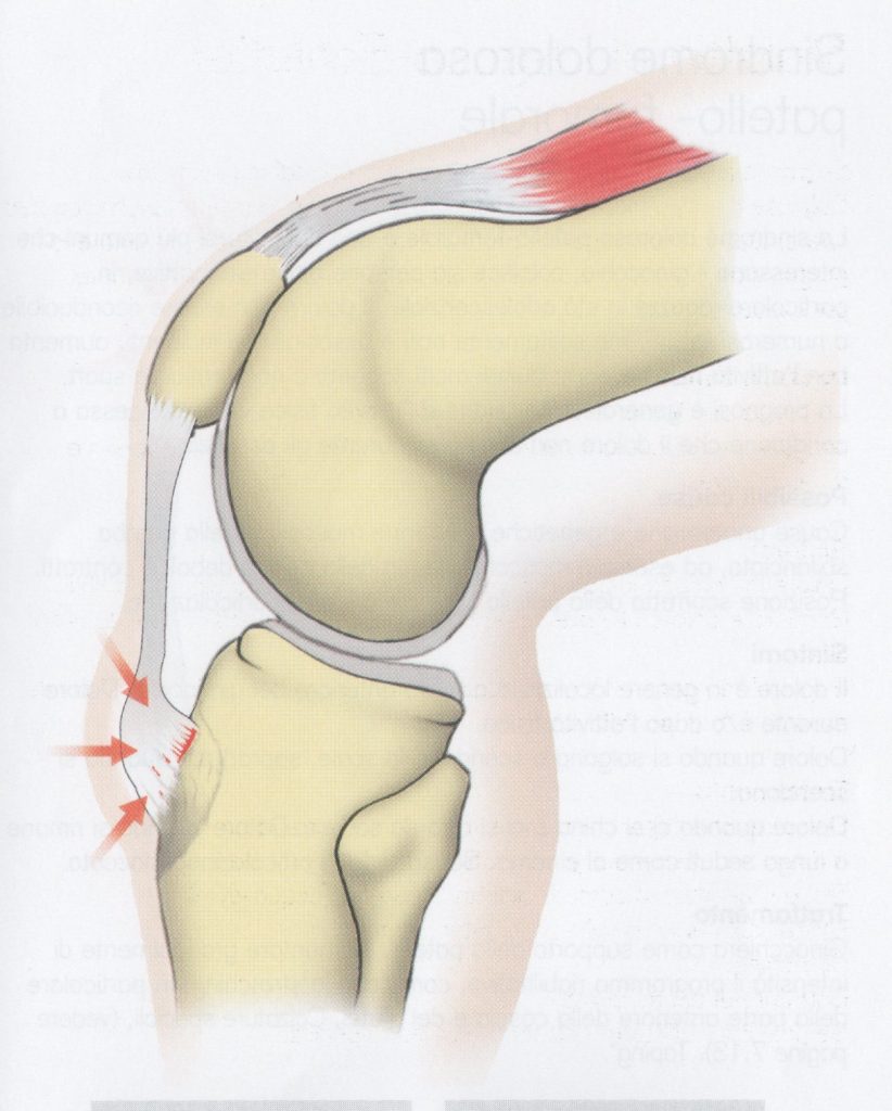 Sindrome di Osgood-Schlatter