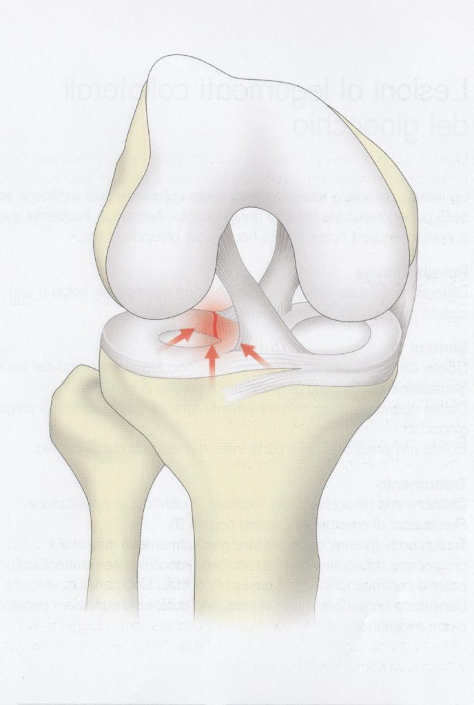 Lesioni al menisco