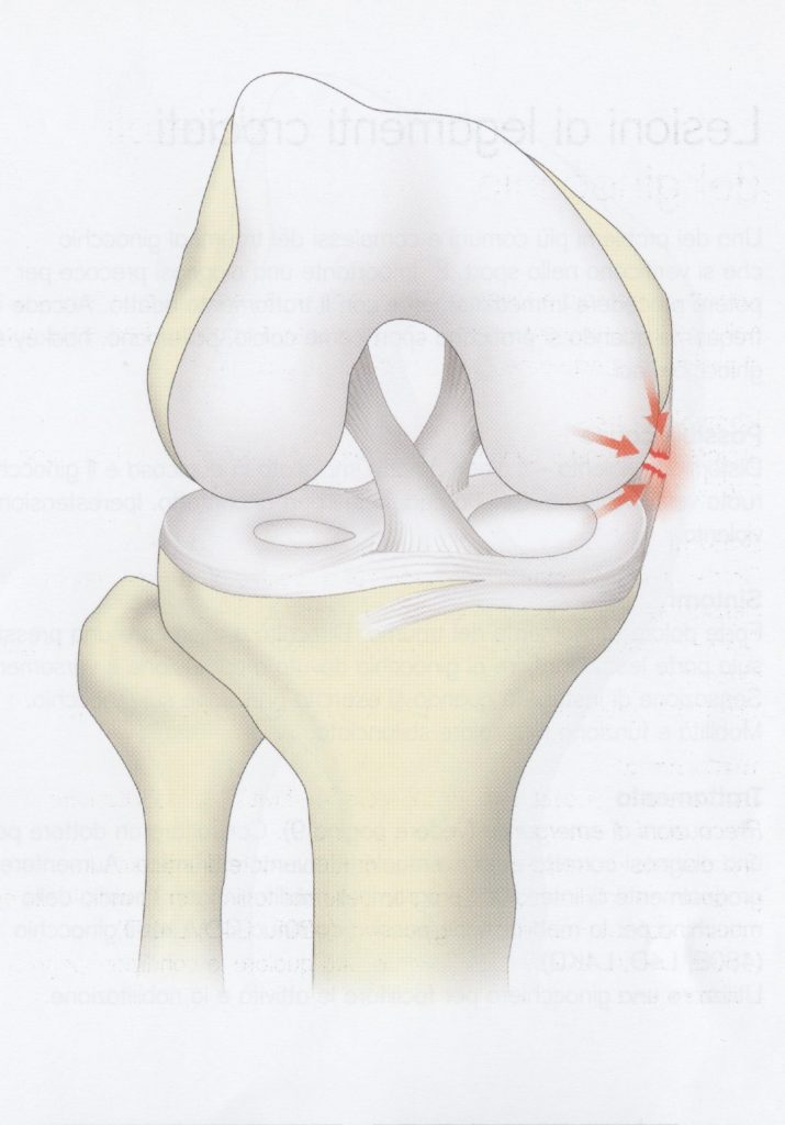 Lesione ai legamenti collaterali del ginocchio