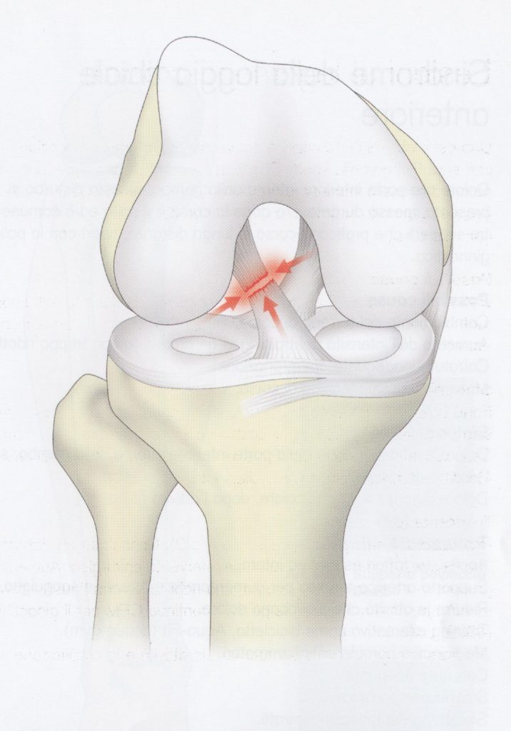 Lesione ai legamenti crociati