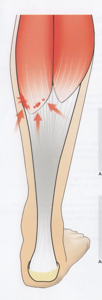 Strappo muscolare al polpaccio