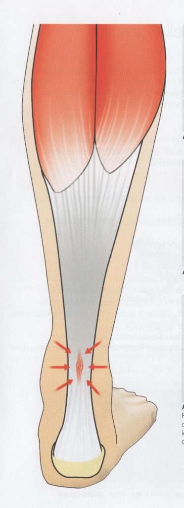 Patologia al tendine di Achille (Achillodinia)