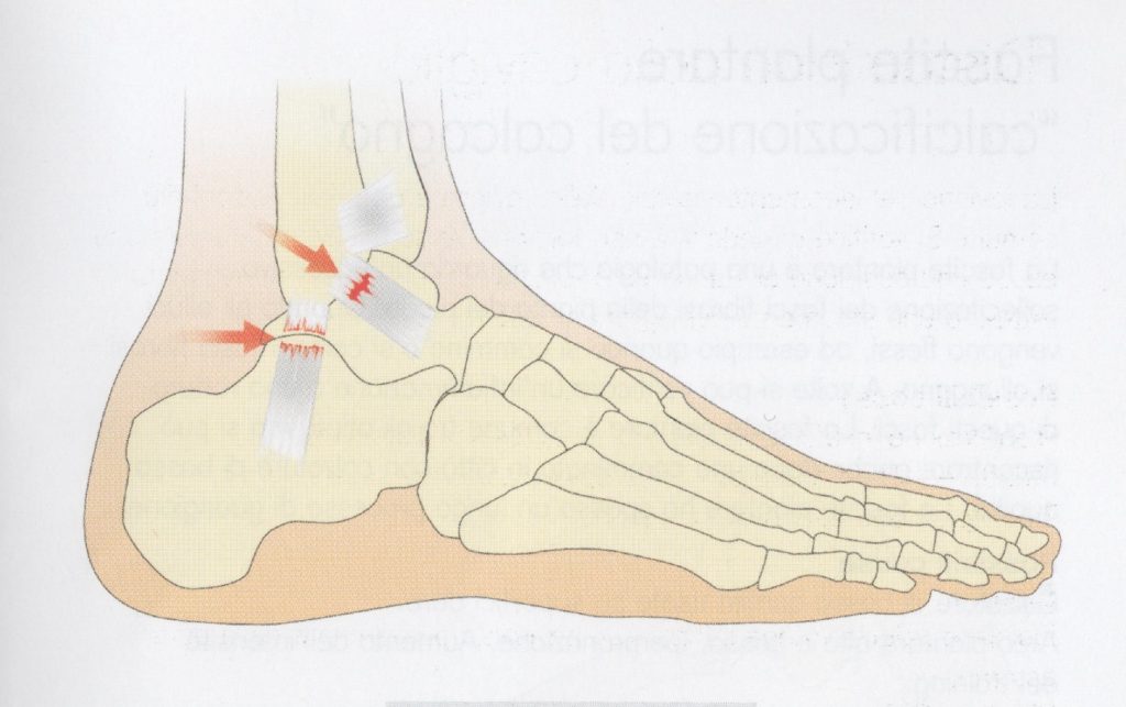 Distorsione della caviglia