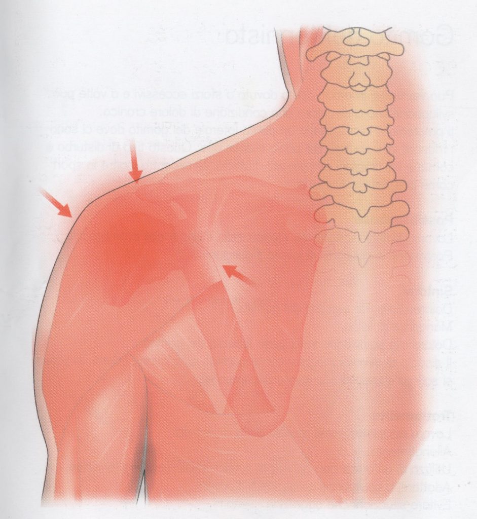 Instabilità dell’articolazione della spalla