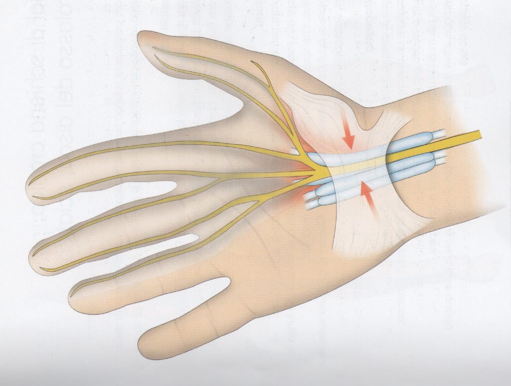 Sindrome del tunnel carpale