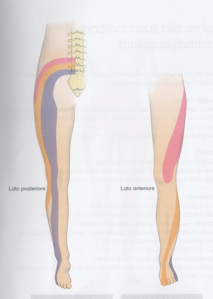 Mal di schiena, sciatica