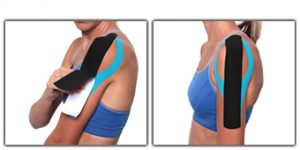 applicazione nastro kinesiologico per taping scapola, spalla e braccio