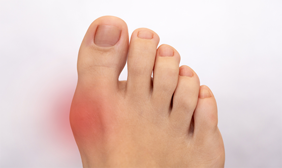 Alluce valgo: quale soluzione?