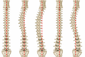 La scoliosi 1