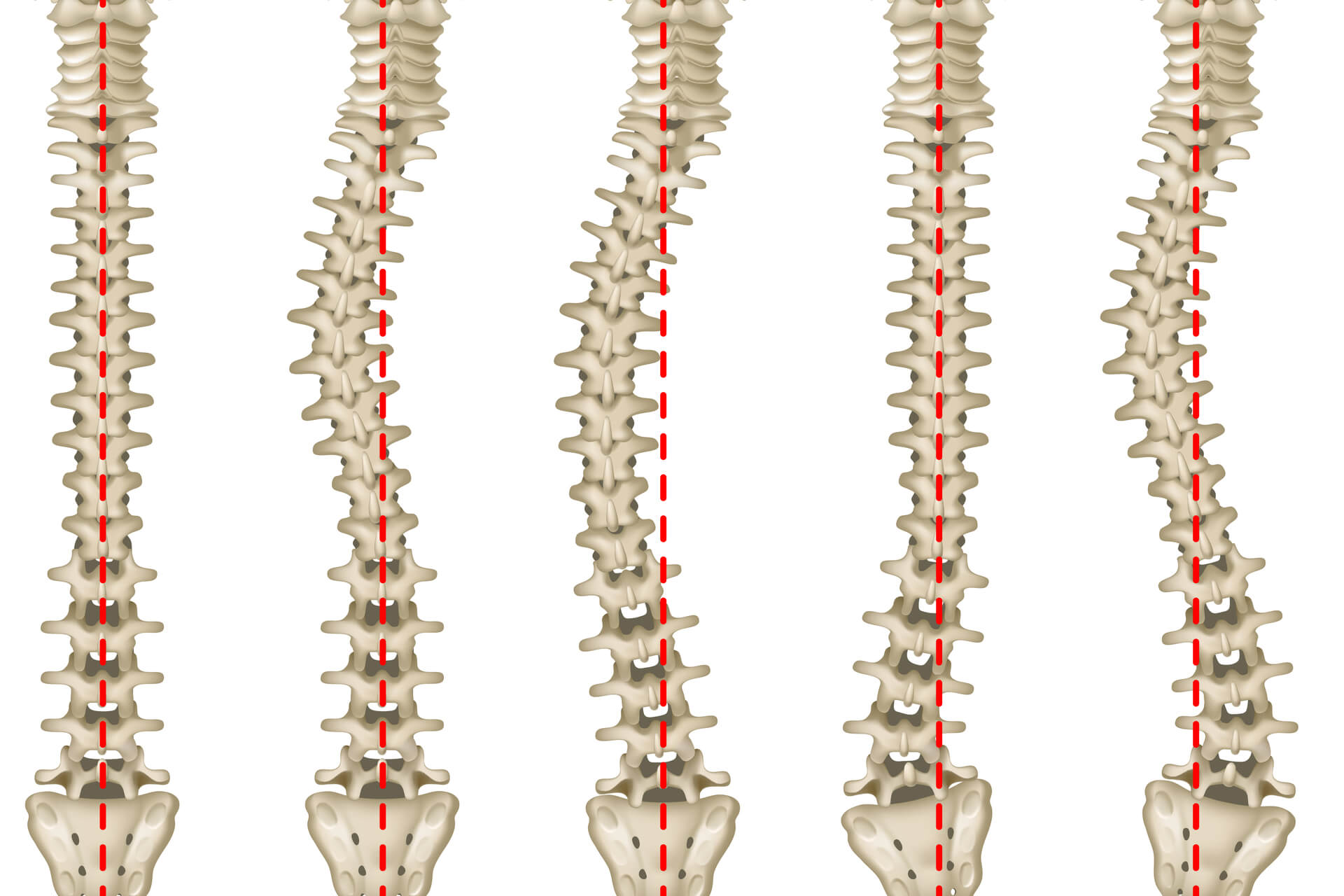 La scoliosi diagnosi