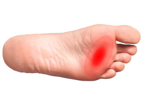 La metatarsalgia: sintomi, cause e soluzioni.